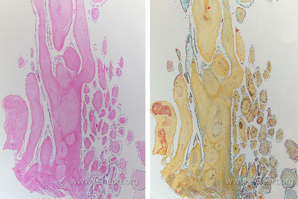 Papillary fibroelastoma light microscopy